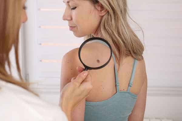 What Are Traditional Skin Lesion Removal Methods Walton-on-Thames?