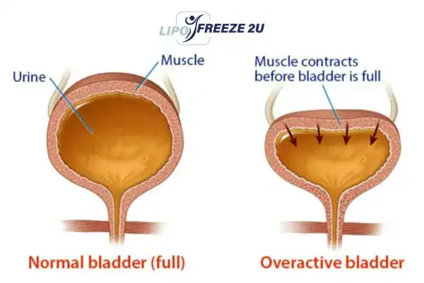 diagram of overactive bladder treatment Walton-on-Thames