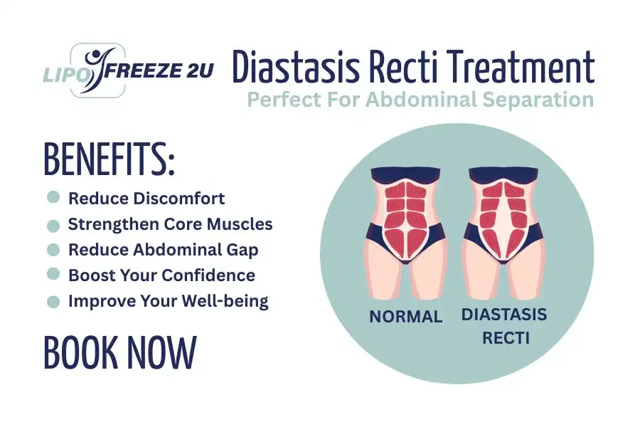 How Long Will It Take to See Improvements in Diastasis Recti Walton-on-Thames