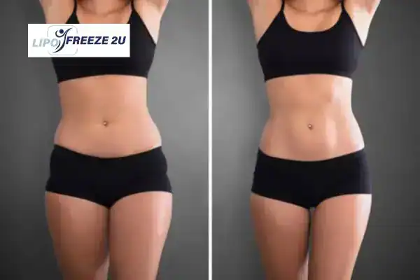 How Can LIPO FREEZE 2U Support Your Post-Pregnancy Body Recovery Walton-on-Thames?