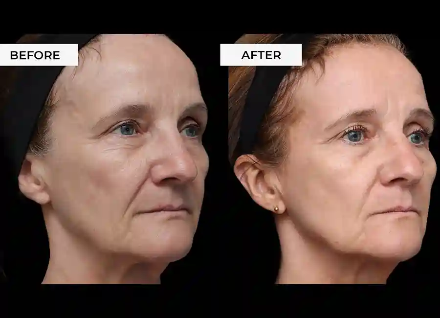 How Many RF Microneedling Sessions Will You Need to See a Difference Walton-on-Thames?
