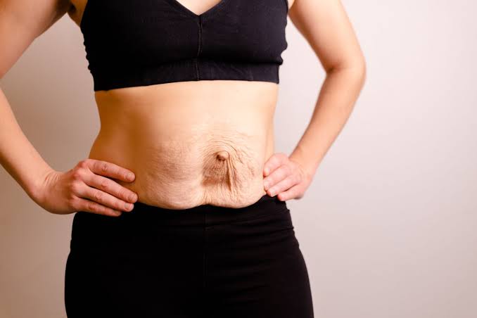 Is Surgery Really the Only Way to Repair Diastasis Recti Walton-on-Thames?