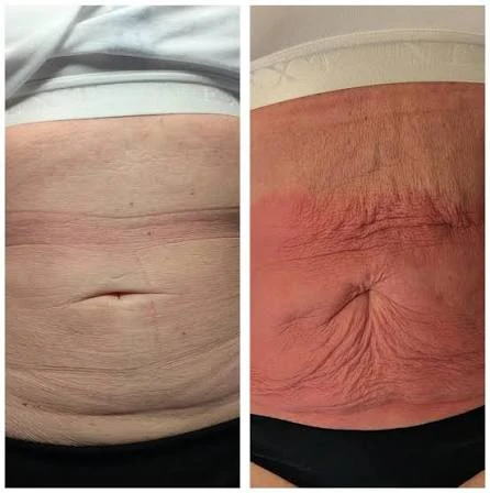 How Does RF Microneedling Improve Crepey, Thin and Uneven Skin Texture Walton-on-Thames?