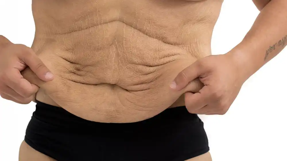 Why Does Weight Loss Medication Leave Some People With Loose or Sagging Skin Walton-on-Thames?